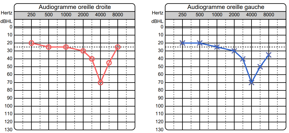 Audiogramme avec encoche pour surdité professionnelle